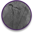 Angiogram of NSTEMI–high-risk anatomy