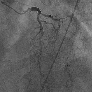 NSTEMI: Angiograms of 80% occlusion of the proximal LAD, bifurcated lesion involving the circumflex artery, and evidence of calcification
